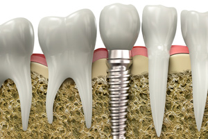 Dental Implants